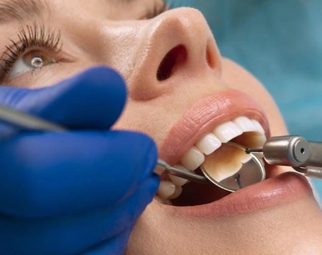 Dentist performing a tooth filling procedure on a patient.