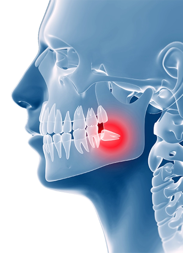 Wisdom tooth removal at Valantine Family Dentistry